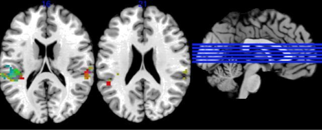 No other brain region was activated within the set significance level of p = 0.001 and the cluster size N > 22.