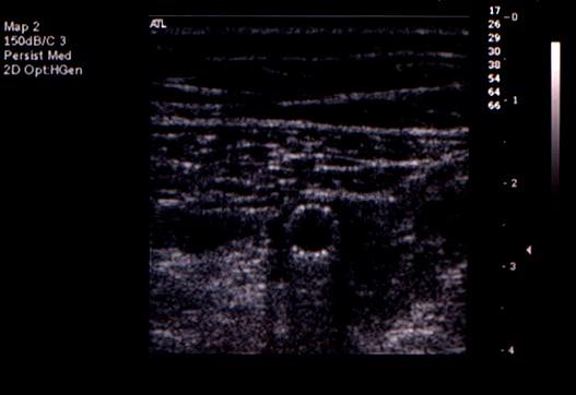 Carotid Duplex Sonography of Endovascular Stents B-mode image: More