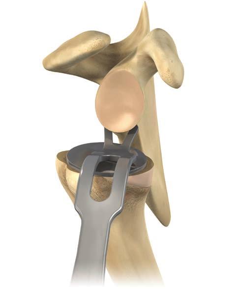 EXPOSING THE GLENOID Position a forked retractor in the axillary margin of the scapula under the inferior glenoid labrum to move the humerus down or backward, depending on the approach taken (Figure