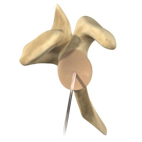 Position the plate as low as possible so that its border follows the inferior edge of the glenoid. Note that inferior osteophytes may result in malpositioning.