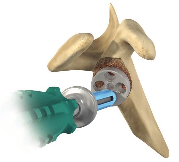 Drill the hole for the superior locking screw anticipating exit through the far cortex using the same methods as Figure 36 (inferior screw placement) (Figure 42).