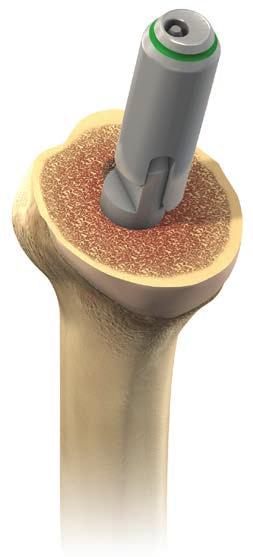 CEMENTLESS MODULAR PROXIMAL HUMERAL REAMING Cementless Modular Humeral Implants MAKE SURE YOU ARE USING THE DEDICATED INSTRUMENTS FOR CEMENTLESS MODULAR IMPLANTS Remove the sizer disk, leaving the
