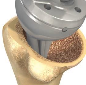 CEMENTLESS MODULAR HUMERAL TRIAL STEM AND EPIPHYSIS INSERTION Cementless Modular Humeral Implants MAKE SURE YOU ARE USING THE DEDICATED INSTRUMENTS FOR CEMENTLESS MODULAR IMPLANTS The component is