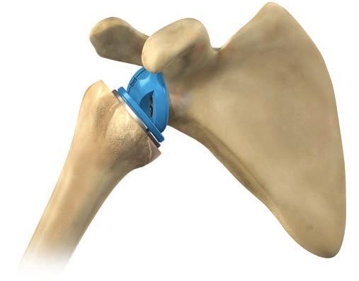 CUP TRIALS AND TRIAL REDUCTION Place the humeral trial cup (38 or 42mm depending on the glenosphere size), with +3mm of lateral offset, in the trial epiphysis (Figure 73).