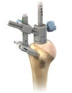 DELTA XTEND KEY SURGICAL STEPS Humeral Surgical Steps Superior-lateral Approach