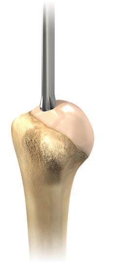 CASES OF PROXIMAL HUMERAL BONE LOSS Cases of proximal bone loss will be treated using cemented monobloc humeral implants to avoid any risk of component dissociation.