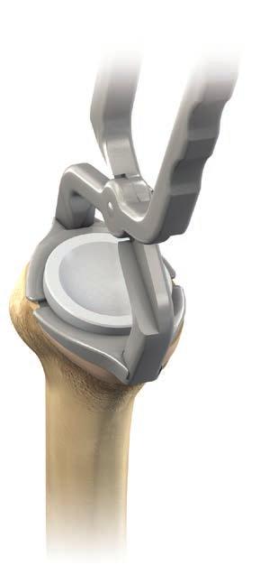 DELTA XTEND SYSTEM REVISION TO HEMI-ARTHROPLASTY When revision of a reverse shoulder is required due to glenoid loosening, or when glenoid bone stock is insufficient to fix a metaglene securely, the