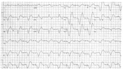 Compare it to a previous ECG Current: 2 months prior:   Compare it to a