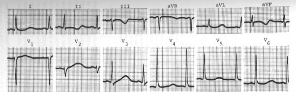 Ventricular Tachycardia Scarcity of data Consider -- Lidocaine gtt -- Procainamide - watch for hypotension and prolonged QT