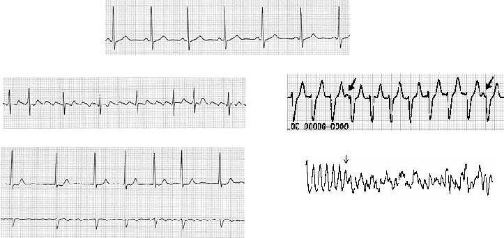 Some Examples of EKG s Arrhythmias By