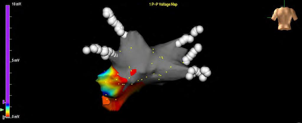 LESSONS FROM SURGEONS Post-ablation voltage map of a patient who