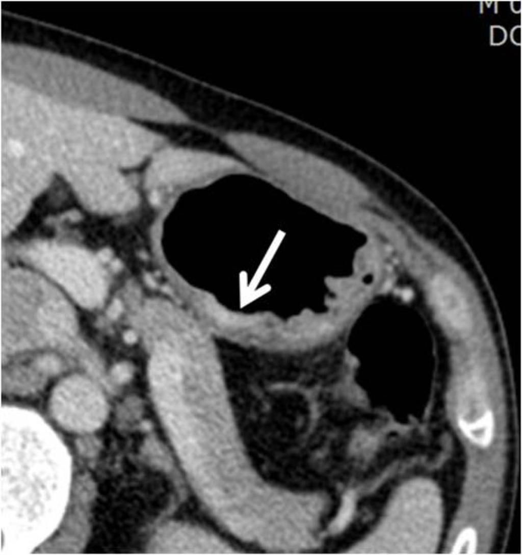Fig. 4: T2 stomach cancer