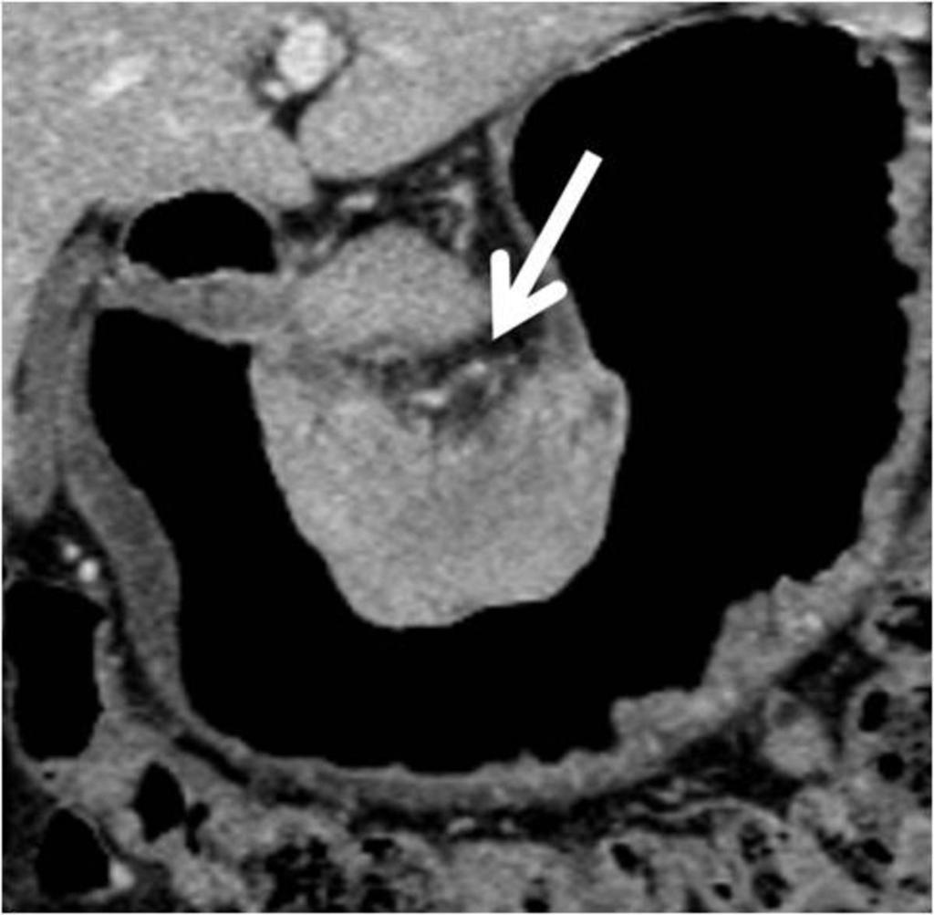 Fig. 7: T3 stomach cancer in a
