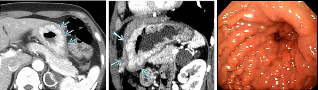 Fig. 21: A 43-year old woman with diffuse-type stomach cancer.