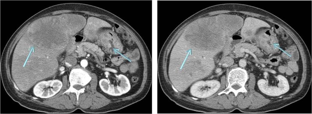 22: Sarcomatoid adenocarcinoma and multiple liver metastasis in a 69-year old woman Fig.