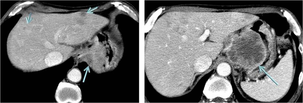 Fig. 24: Squamous cell carcinoma of the stomach and liver metastasis in a 56-year old man.