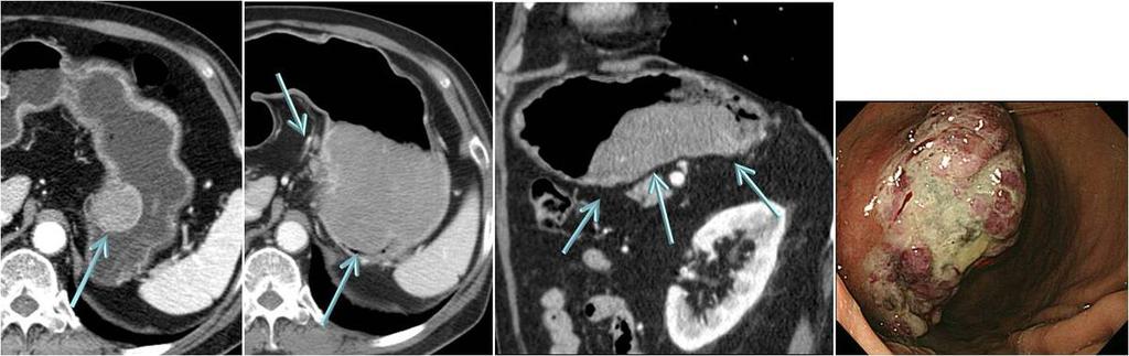 25: A rapidly growing subepithelial tumor of the gastric cardia in a 82 year-old man, which