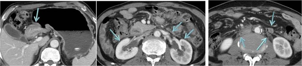 Fig. 31: Direct invasion of mid jejunum by stomach cancer at