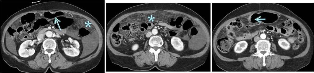 Fig. 32: A 69-year old man with AGC and ureter metastasis Fig.
