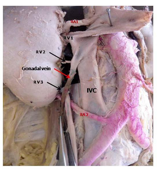 Figure 1: Photograph showing presence of two renal arteries (RA1 & 2)