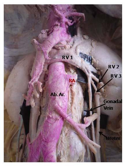 Figure 3: Photograph showing three renal veins on left side (RV1,2& 3).