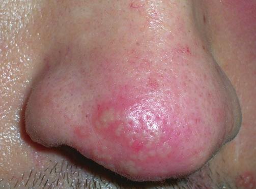 Viral and bacterial infections, immunobullous dermatoses and photodermatoses are the major diseases that present with vesicles, bullae and pustules on the nose.