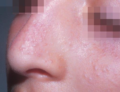 This disease is mostly seen before puberty. Papules and sometimes vesicles can be seen on the tip of the nose which usually seems wet because of regional excessive sweating (Fig. 2.1, 2.2).