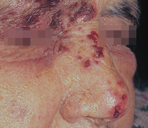 Lesions may last longer when compared with herpes zoster lesions of the trunk. Systemic antiviral therapy is indicated to prevent the complications like uveitis and keratitis.
