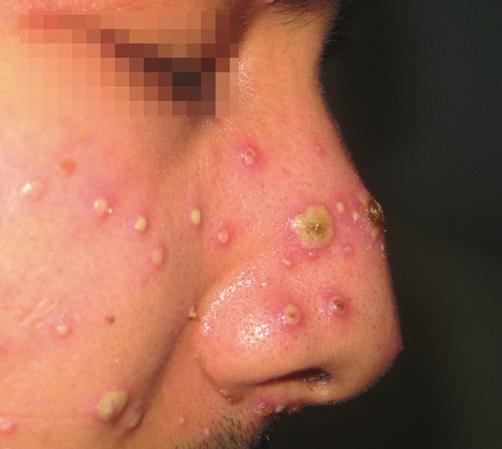 It is most common among children (Fig. 2.6). Clinically it can be seen as bullous and nonbullous impetigo (impetigo contagiosa).