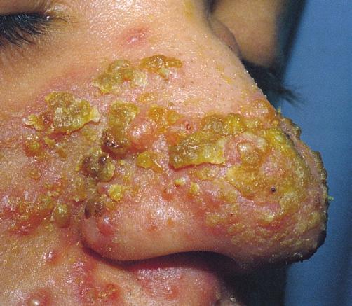 Acne vulgaris is commonly seen on the nose where the hair follicles are dense and the secretion of seborrheic glands is increased. Lesions also involve other parts of the face and sometimes the ears.