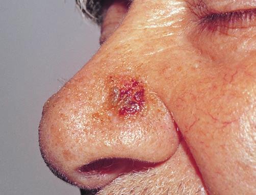 Pemphigus vulgaris should be suspected when there are non-healing erosions and crusts on the nose (Fig. 2.13, 2.14). Intact flaccid blisters are not common in this area.