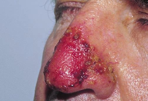 Although rare, it must be remembered that pemphigus vulgaris may be restricted to the nose and may relapse after therapy at the same site.