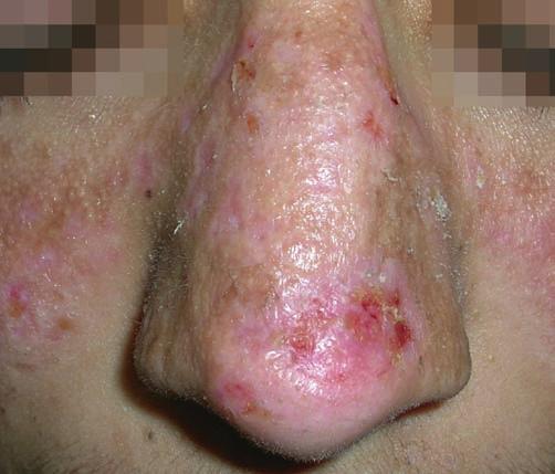 Bullous pemphigoid may occasionally be seen on the nose both with intact bullae and erosions. Linear IgA dermatosis may present with tense nasal bullae on an erythematous base in adults.