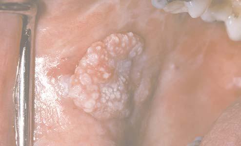 Oral Cancer and Precancerous Lesions 14 15 16 Figure 14 Squamous