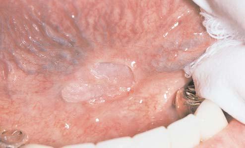 Ulcerated lesion of the ventral tongue/floor of mouth.
