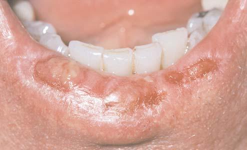 anterior floor of mouth and alveolar ridge.
