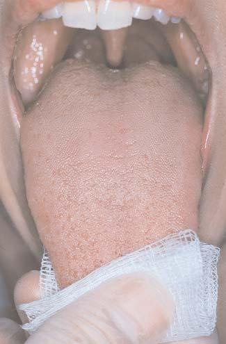 2,89 Oropharyngeal carcinomas have a clinical appearance that is similar to cancers found in the oral cavity proper (Figure 19).