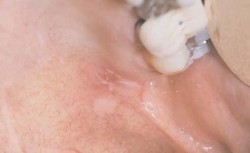 more irritation during mastication. This should not be mistaken for true leukoplakia, and biopsy is not indicated.
