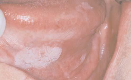 Figure 5 Thick leukoplakia. This thick white lesion on the lateral/ventral tongue showed moderate epithelial dysplasia.