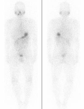 Identification of multiple iodine-avid lymph nodal metastases led to