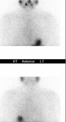 Follow-up Thyrogen 131-I scan (1 yr post-rx) rhtsh-stim. Tg < 0.