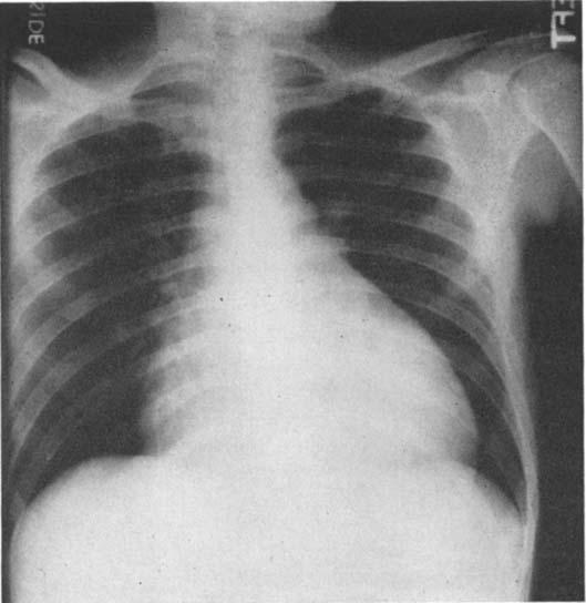 PRIMICH AND MAIER FIG. 1. X-ray at time of pericardial effusion. adjacent vessels suggestive of a nonvascular mass in the supracardiac portion of the mediastinum.