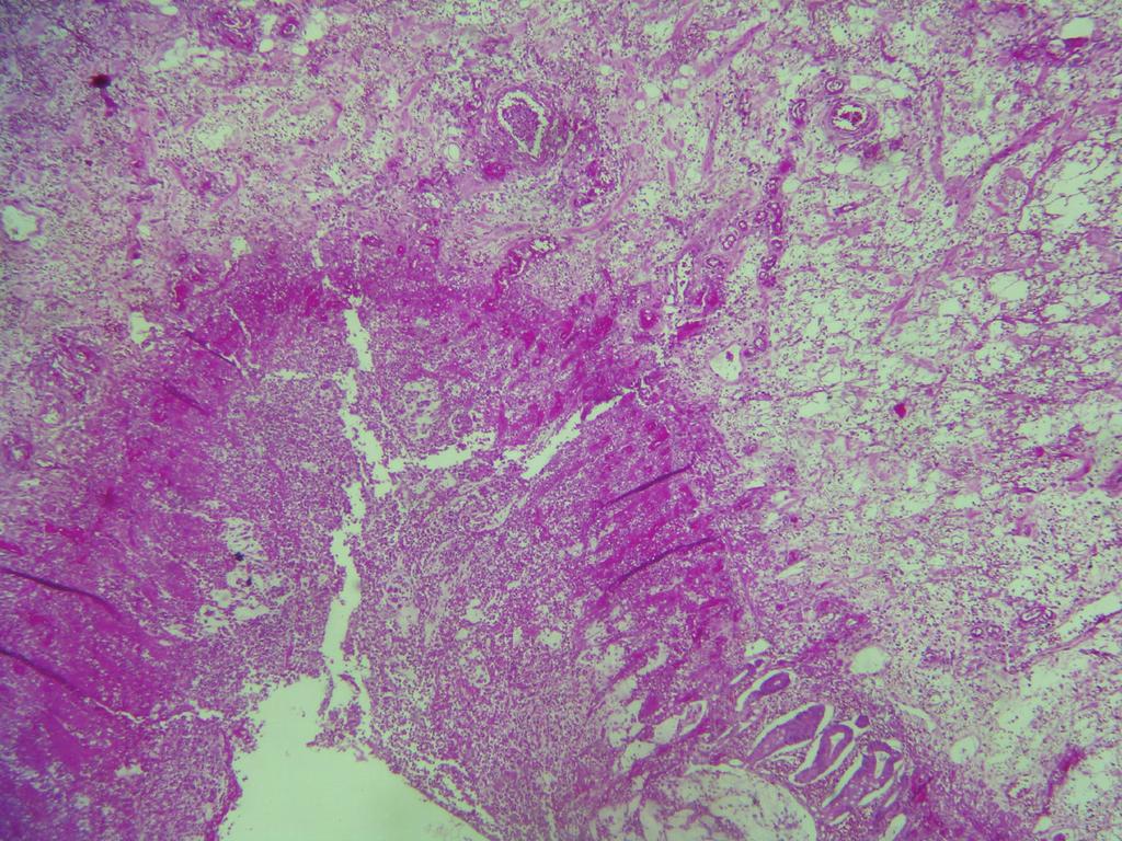 2 Case Reports in Medicine Figure 1: Mucosa with necrosis and hemorrhagic lesions. Submucosa dissociated with exudatif rearrangement (HE 40).