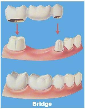 Product description A dental bridge is a fixed dental restoration which is used to replace a missing tooth.