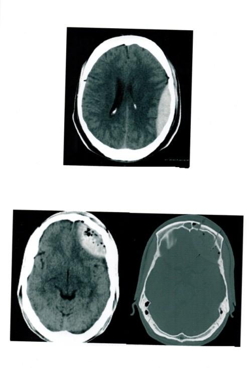 03% 18-30 years 19% 31-50 years 15% Axial NECT in a patient with trauma shows SUBGALEAL HEMATOMA (arrows) in the left parietal region and Axial NECT shows a linear fracture
