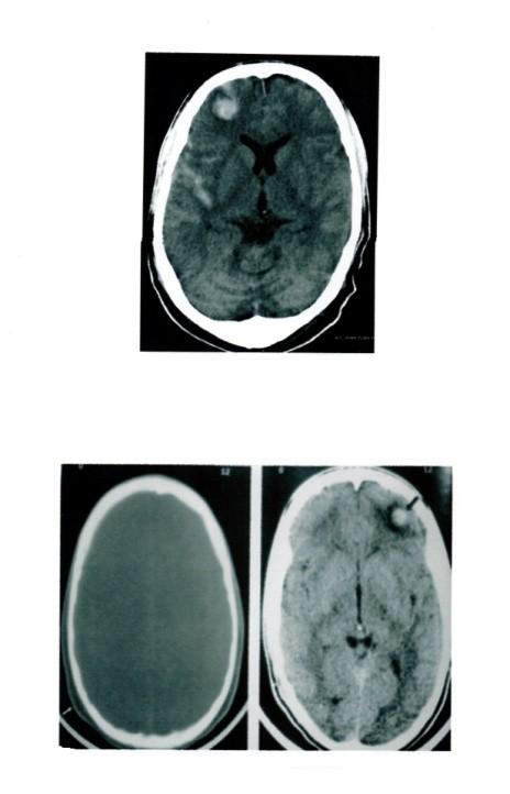 Axial NECT in a patient with trauma shows DIFFUSE AXONAL INJURY (bilateral frontal white matter hyperdensities (Arrows) with diffuse CEREBRAL EDEMA and axial NECT in a patient with trauma shows
