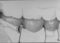 Occlusal pattern on the left side was group function.
