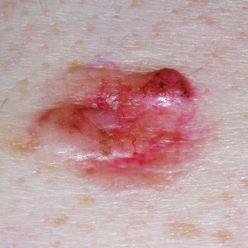 What are the signs of non-melanoma skin cancer?