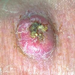 bleeding A lump that is firm, scaly or has a crusted surface, and may be sore