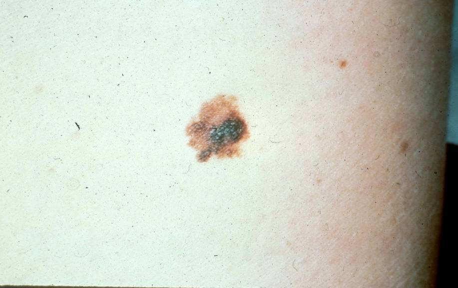 Risk Factors Red/blond hair Family history of melanoma Sun exposure in childhood/intermittant sun exposure Multiple nevi-typical and atypical in fair-skinned persons Melanoma- Miller AJ-NEJM July